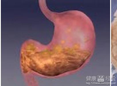 胃溃疡吃瓜花好